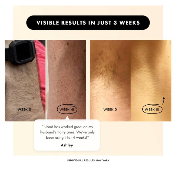 Flasher 2.0 by Nood, IPL Laser Hair Removal Device Pain-free and Permanent Black - Picture 5 of 10